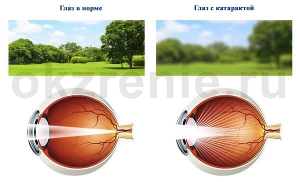 Начальная катаракта